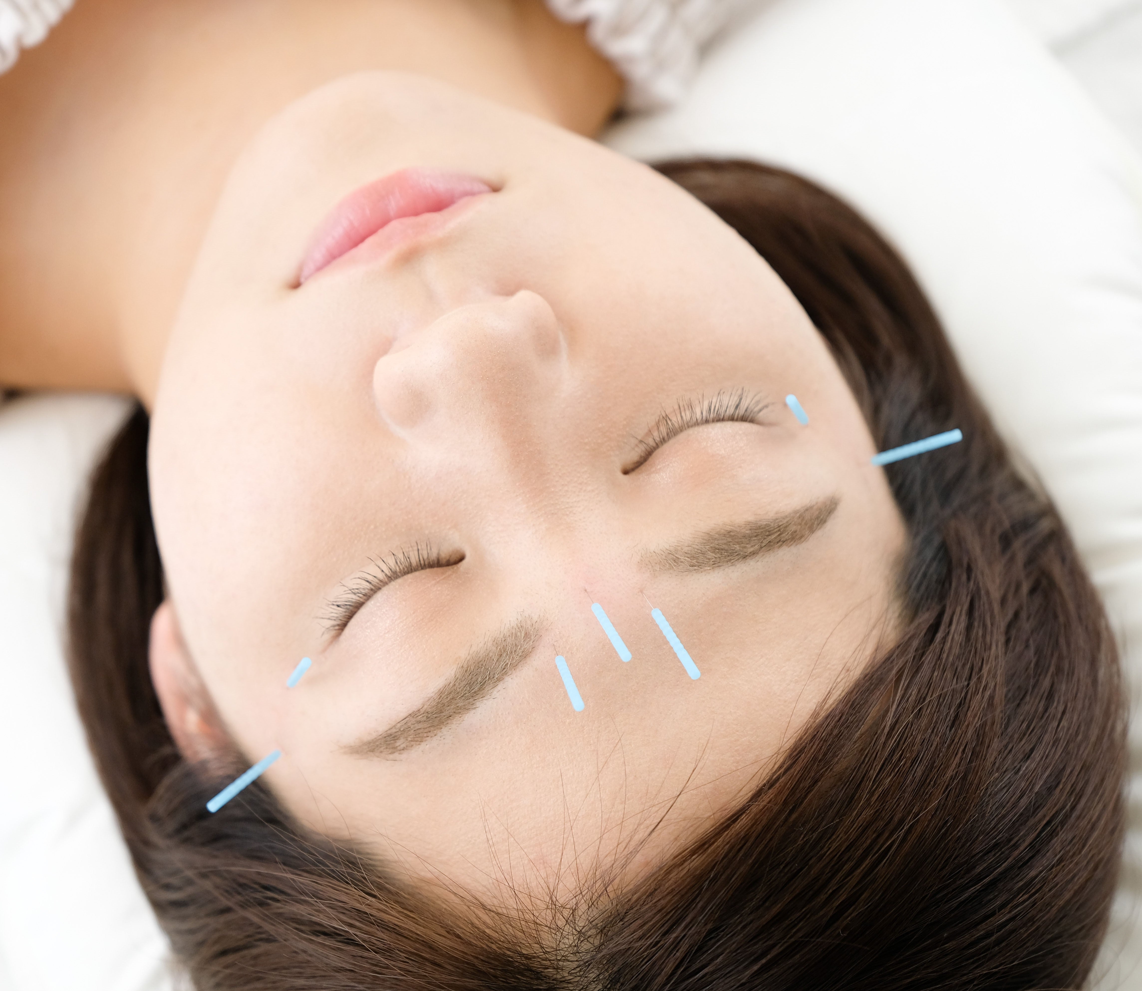 una mujer joven recibiendo un tratamiento de acupuntura para una belleza integral